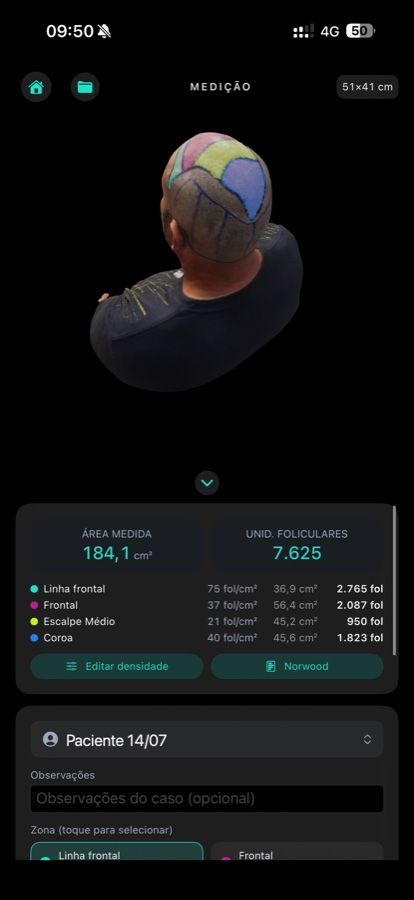 Tela de medição do Graftlas: modelo 3D com as quatro zonas pintadas, área de 184,1 cm², estimativa de 7.625 UF e a densidade de cada zona.