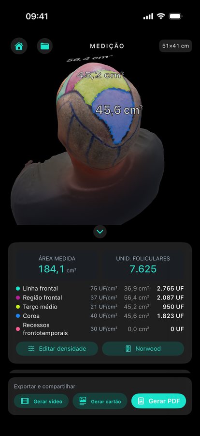Tela de medição do Graftlas: modelo 3D com as quatro zonas pintadas, área de 184,1 cm², estimativa de 7.625 UF e a densidade de cada zona.