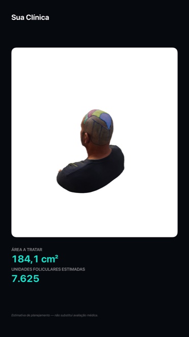 Cartão exportado pelo Graftlas: modelo 3D do couro cabeludo com as zonas pintadas, área de 184,1 cm² e estimativa de 7.625 unidades foliculares, com a marca da clínica no topo.